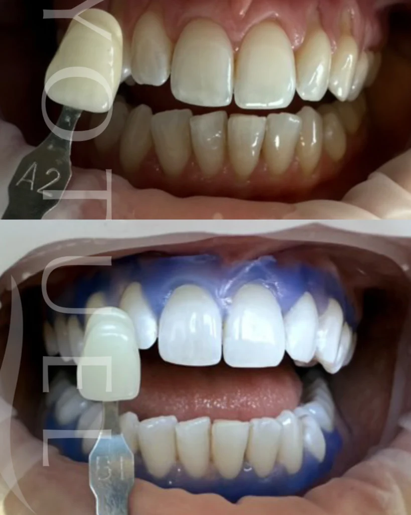 Wybielanie zębów efekty